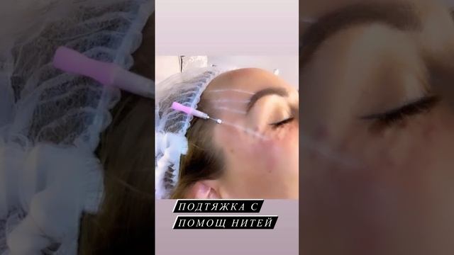 Подтяжка бровей с помощью коллагеновых нитей