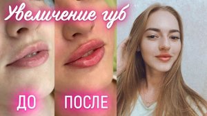 УВЕЛИЧЕНИЕ ГУБ ВТОРОЙ РАЗ   ОЩУЩЕНИЯ ВО ВРЕМЯ ВКОЛОВ  РЕЗУЛЬТАТ НЕ ОПРАВДАЛ ОЖИДАНИЯ