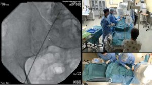 Баллонная ангиопластика и стентирование правой подвздошной артерии