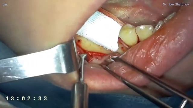 Cytoplast мембрана. Вертикальная и горизонтальная направленная костная регенерация www.apexdental.r