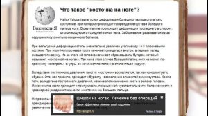вальгус стопы лечение / как лечить подагру народными средствами