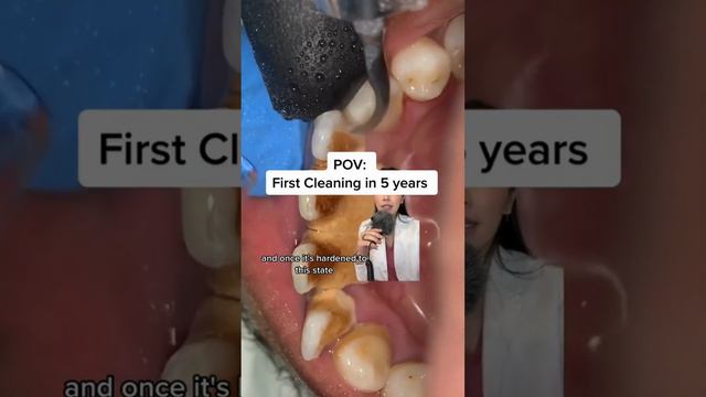 When a patient hasnt gotten a cleaning in a while,plaque can calcify into tarta | Dentistry Explain