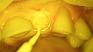 22 коагиляция+билдап