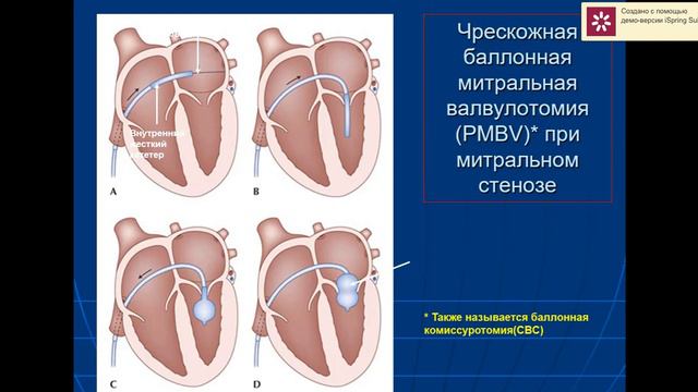 Юрак митрал ва аортал клапан нуксонлари смотреть онлайн