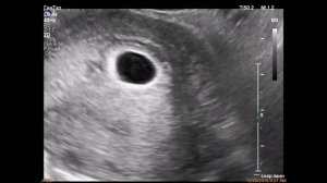 Замершая беременность