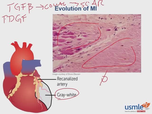 USMLE RX - 2.Кардиология - 3.Патология - 15. Эволюция Инфаркта Миокарда (ИМ)