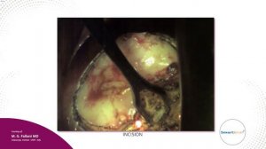 COLPOSCOPY - Endocervical HSIL CIN III