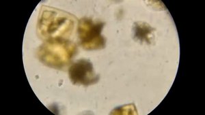 Моча под микроскопом.  Кристаллурия 5