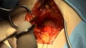 Грыжепластика по Лихтенштейну lichtenstein hernioplastika