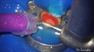 Изготовление культовой вкладки прямым методом из пластмассы , dental , dentistry , dentist , tooth
