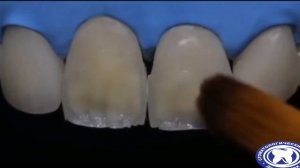 Наращивание зубов с восстановлением эстетики