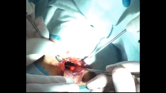 Реконструкция орбиты 3D имплантатом смотреть онлайн