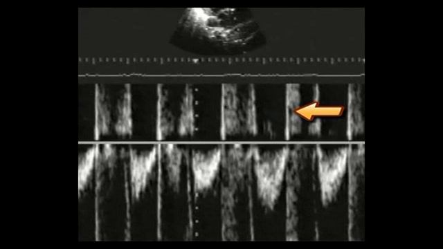 27. Аномалии конотрункуса, часть 1. Общий артериальный ствол и тетрада Фалло смотреть онлайн