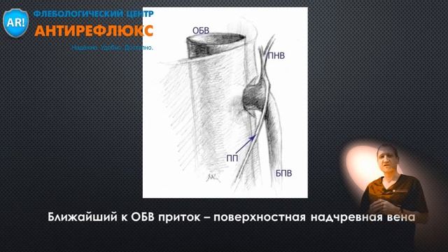 УЗИ вен. Классификация СФС по ближайшему притоку