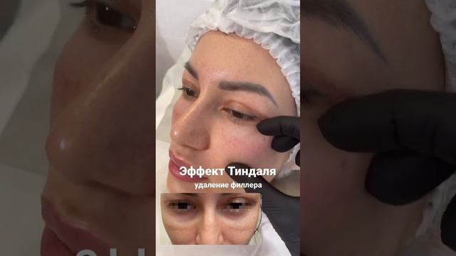 Эффект Тиндаля, удаление филлера из носослезной борозды. смотреть онлайн