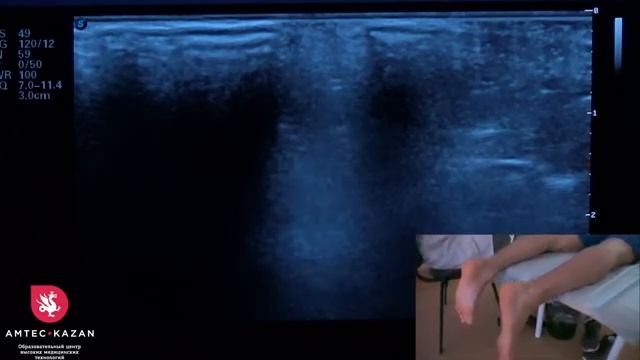 #УЗИ голеностопного сустава техника сканирования. смотреть онлайн
