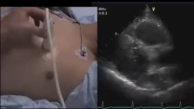 Intro to Echo Parasternal Views.mov смотреть онлайн