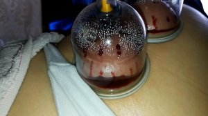 Хиджама. Иглоукалывание. Банки. Каппинг. Кровопускание.