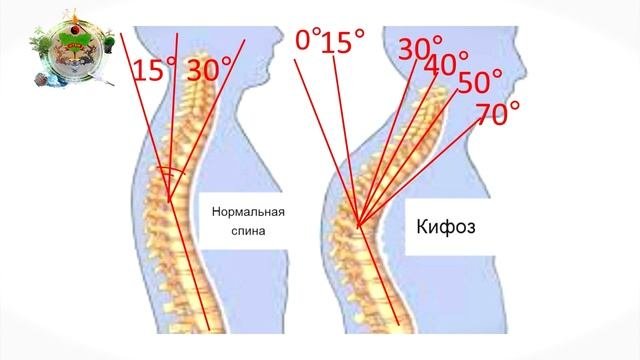 Что такое Кифоз или Сутулость?   Владимир Поляков, врач невролог, мануальный терапевт, а