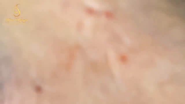 Blackhead Removal With Sac Dep Spa @1000248 смотреть онлайн