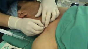 Блокада плечевого сплетения (надключичная блокада)