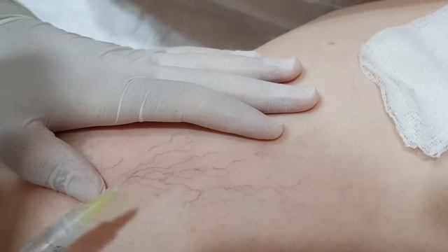 гиперпигментация после склеротерапии чем мазать синяки после тромбофлебит после склеротерапии БАКУ