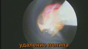 Полип шейки матки. Быстрое и эффективное удаление