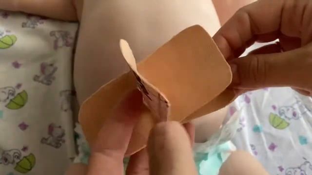 Тейпирование пупочных грыж и слабости пупочного кольца!