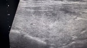 Гистология: папиллярный рак щитовидной железы