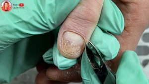 Ожог ногтей / Химический ожог ногтей / Часть 2