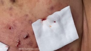 Big Cystic Acne Blackheads Extraction Blackheads & Milia, Whiteheads Removal Pimple Popping