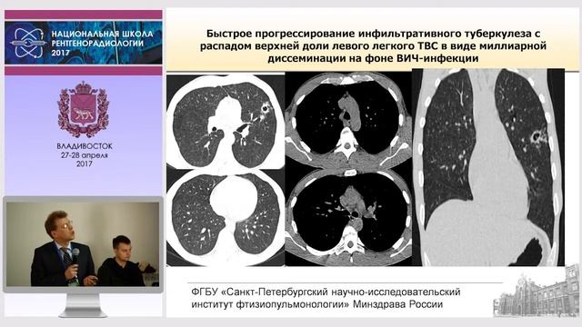 П.В. Гаврилов - Особенности визуализации туберкулеза органов дыхания у пациентов с ВИЧ-инфекцией смотреть онлайн