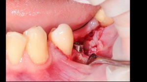 Гингивопластика, аугментация мягких тканей, субэпителиальный трансплантат.Хирургия.Стоматология.