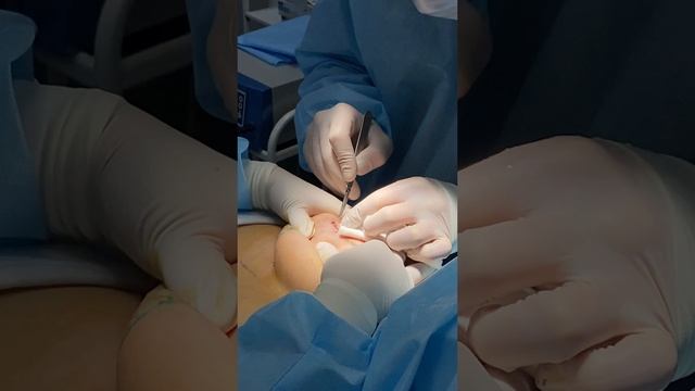 Уменьшение + подтяжка груди / пластическая хирургия