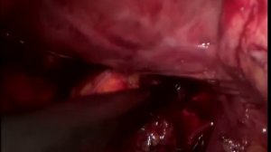 Лапароскопическая адреналэктомия