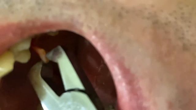 Удаление зуба в домашних условиях смотреть онлайн