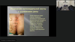 Запись вебинара «Эпителиальный копчиковый ход» - Заводчиков С.А. (28.08.2018)