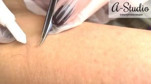 Процесс электроэпиляции в A-Studio