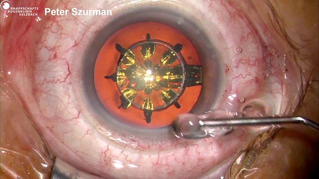 Live Chirurgie: Femto-Katarakt Operation mit dem Ziemer Z8 – Szurman