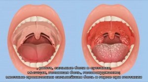 Чем отличается фарингит от ангины