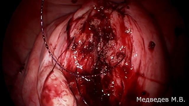 Лапароскопическая миомэктомия при субмукозной миоме