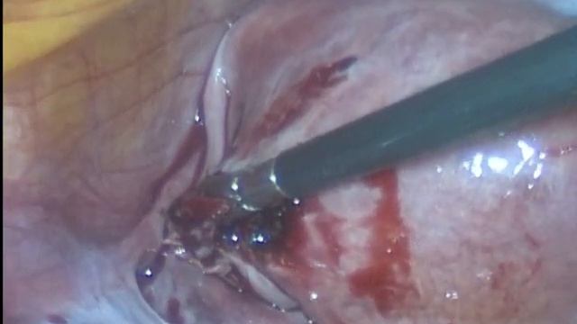 Гигантская миома матки. Миомэктомия.