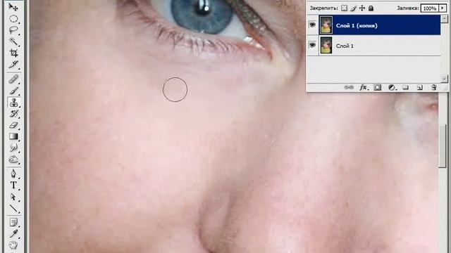 Удаление кругов под глазами смотреть онлайн