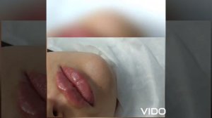 увеличение губ 1 мл