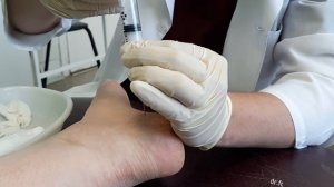 ПЯТОЧНАЯ ШПОРА | Лечение | Блокада | Plantar Fasciitis Injections