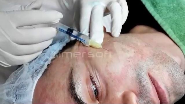 Биоревитализация. Линейный способ введения