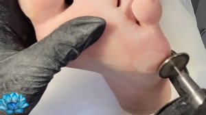 Стержневая мозоль. Удаление стержневой мозоли. Смарт педикюр.