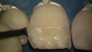 Реставрация передних зубов Др.Ванини