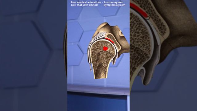 Shoulder Pain Caused by Sprain