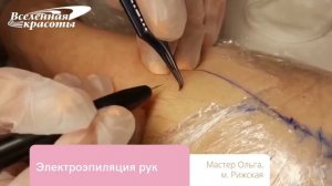 Электроэпиляция рук методом blend